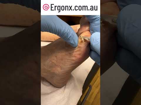 Little Toe Transformation: Watch Podiatrist Remove Stubborn Hard Skin #FootCare #Podiatry