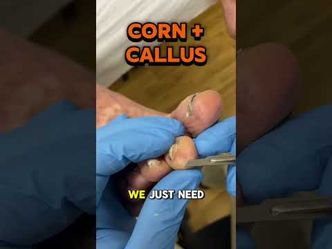 Painful corn on the tip of the second toe? This is what happens when your toes are gripping the
