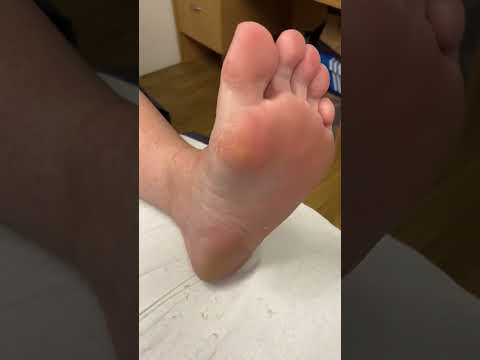 Transform your feet with us! This big toe is getting a makeover as we tackle that stubborn hard skin