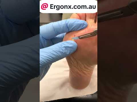 How Podiatrists Safely Remove Painful Foot Corns