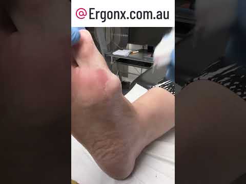 Ultimate Foot Care Transformation: Watch a Callus Removal with a Scalpel #FootCare #CallusRemoval