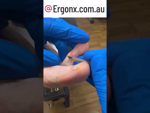 Say Goodbye to Toe Pain: Watch This Corn Removal by a Podiatrist #FootCare #Podiatry