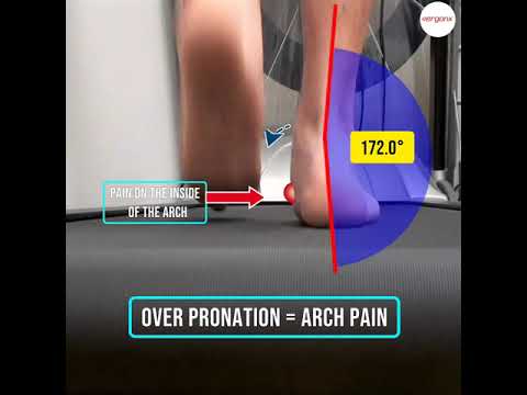 Arch Pain and Overpronation: Support Options