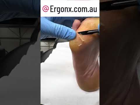 Say Goodbye to Painful Feet: Fix Thick Calluses from Heels Fast! #FootCare #CallusRemoval