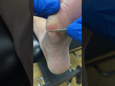 Satisfying Callus Removal by Podiatrist #CallusCutting #FootCare #SatisfyingVideos