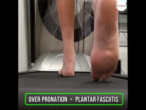 When we look at someone walking from behind, one of the most common things we see in clinic is