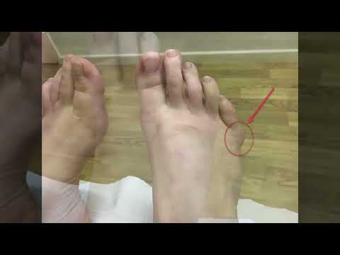 Discover what causes a Tailor’s Bunion and how to treat it effectively!👣✨ Say goodbye to discomfort