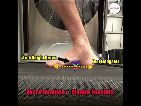 Defeat Plantar Fasciitis: How Overpronation Affects Your Feet #PlantarFasciitis #FootHealth