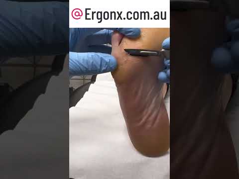 Satisfying Callus Removal on Foresoot Relieves Pain #CallusRemoval #SatisfiedViewer