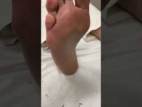 Watch this satisfying forefoot callus removal using a scalpel! 😲🦶 Swipe for the before and after