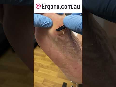 Satisfying Corn & Callus Removal by Podiatrist! #FootCare #SatisfyingVideos