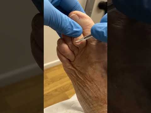 Prevent Toe Ulcers: Avoid Infection and Amputation