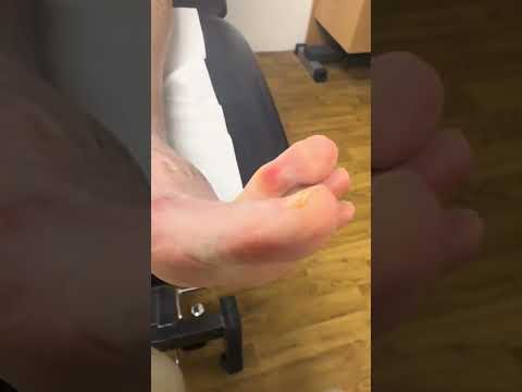 Instant Relief: Removing Painful Corns Between Toes at a Podiatry Clinic #FootCare #Podiatry