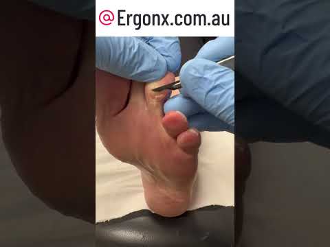 Ultimate Callus Removal on Toe in Podiatry Clinic #FootCare #Podiatry