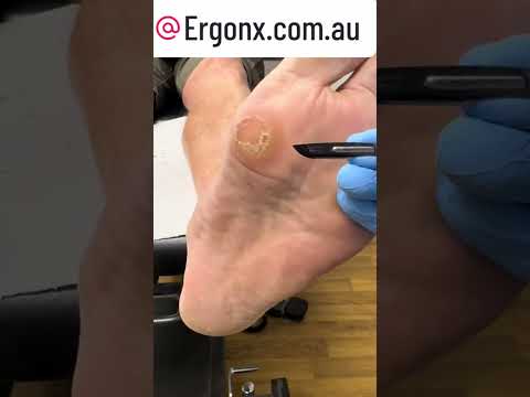 Forefoot Callus Removal: Podiatry Care for Trades