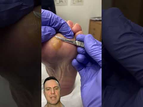 Discover what causes large calluses and how to prevent them! 👣✨ Dive into foot care tips that keep