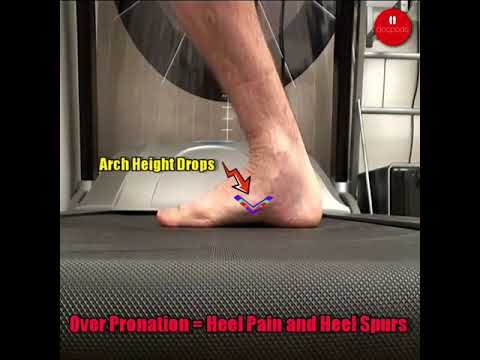 Struggling with heel pain and plantar fasciitis due to overpronation? Discover life-changing tips to