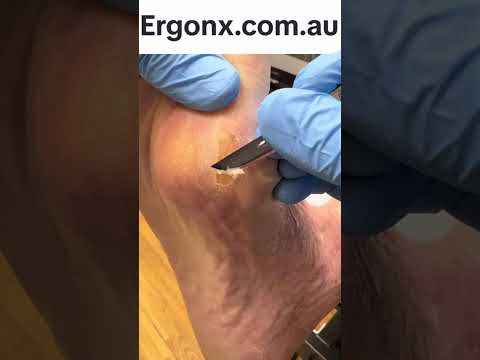 Bunion Calluses: Podiatry Removal and Care
