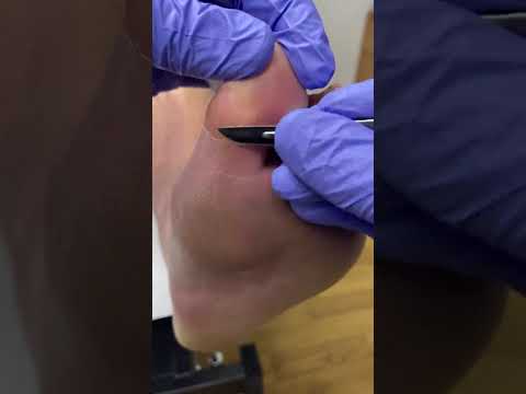 Watch this satisfying transformation as a podiatrist tackles tough calluses on the big toe! Say