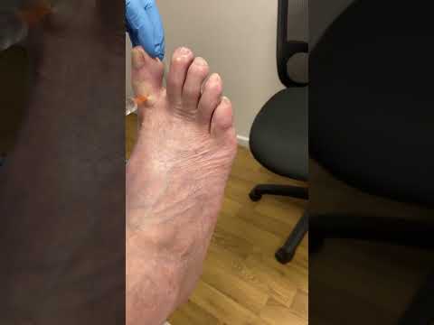 🌟 Toe relief like never before! 🙌 Discover the magic of local anaesthetic for toe discomfort - a