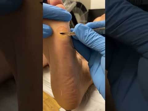 Ultimate Callus Removal Satisfaction Thick Forefoot Transformation by Podiatrist