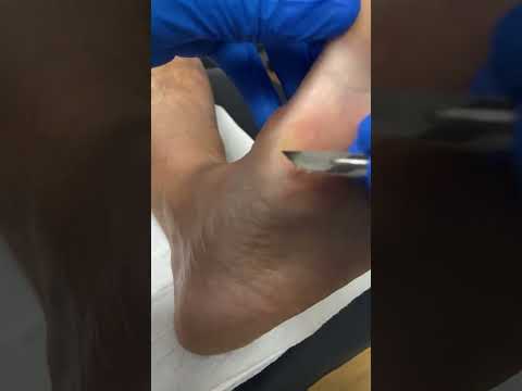 Ultimate Guide to Bunion & Callus Removal in Podiatry Clinic #FootCare #Podiatry