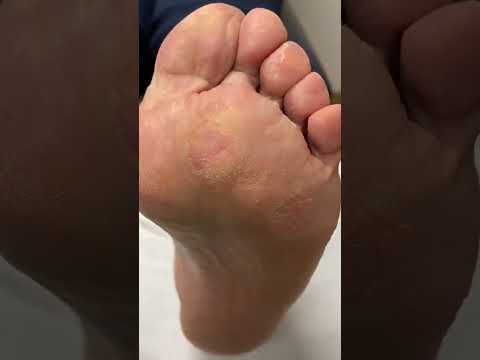 Transforming my feet from rough to smooth! 🌟 Watch as I tackle this stubborn forefoot callus with a