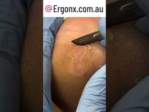 Podiatrist Fixes Deep Heel Cracks With Precision Foot Care #Podiatrist #FootCare