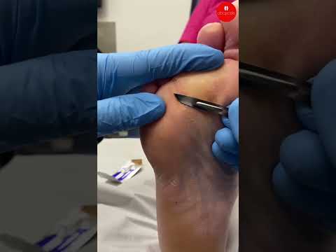 Trimming Callus Over a Neuroma Surgery Scar