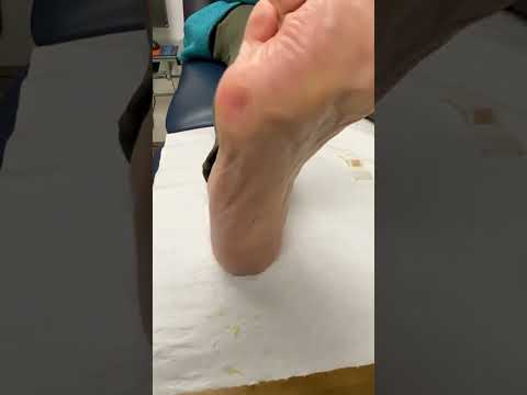 Watch as experts work their magic on stubborn corns! 👣✨ Say goodbye to discomfort and hello to