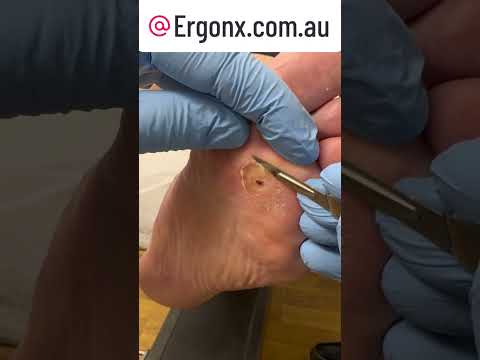 Satisfying Slow-Mo Callus Removal at Podiatry Clinic #CallusRemoval #FootCare