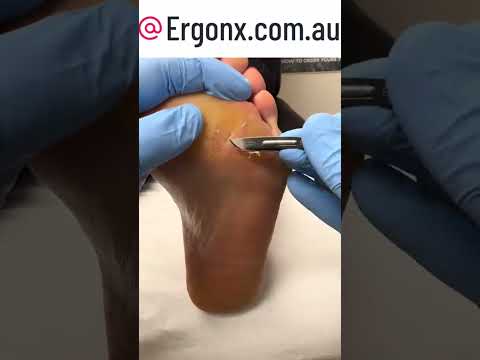 Satisfying Thick Foot Callus Removal in Podiatry Clinic #FootCare #SatisfyingRemoval