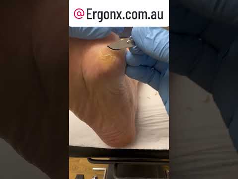 Satisfying Podiatrist Skin Cutting Transformation #Satisfying #Podiatrist #Skincare