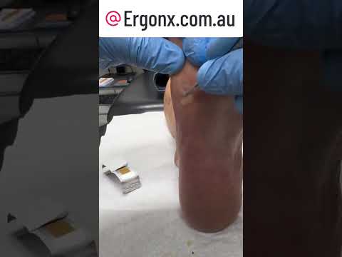 Ultimate Foot Transformation Satisfying Corn & Callus Removal by Skilled Podiatrist