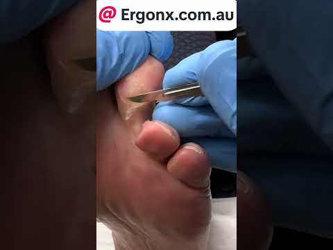 Podiatrist Painfully Removes Corn and Callus Transformation #FootHealth #Podiatry