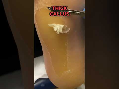 Outside Foot Callus 👣 Ever wondered why some people always get hard skin on the outside of their