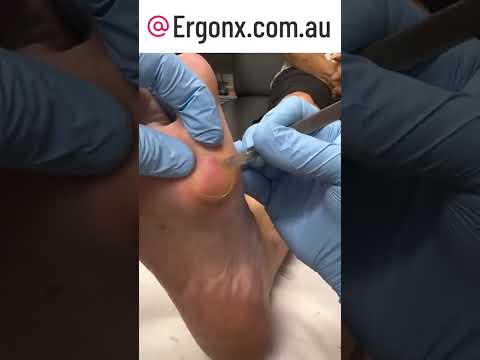 Satisfying Foot Callus Removal by Podiatrist Using Scalpel #FootCare #CallusRemoval