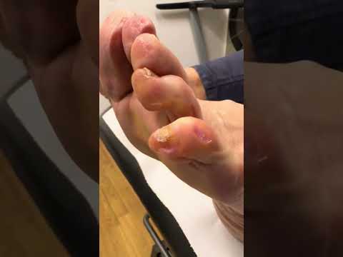 Little Toe Corn & Callus Removal: Podiatrist Care