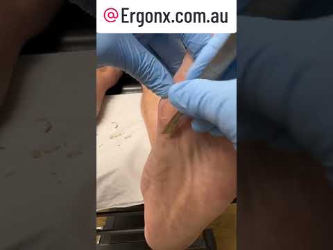 Ultimate Forefoot Callus Removal Secrets Revealed #PodiatryTips #FootCare