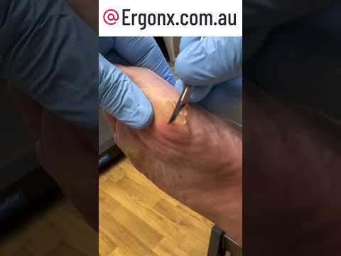 Satisfying Big Toe Hard Skin Removal by Podiatrist Clinic Transformation #FootCare #Podiatry
