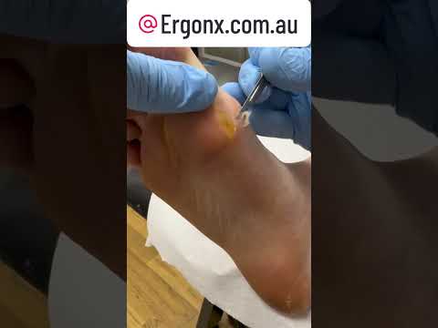 Satisfying Callus Cutting in Podiatry Clinic ASMR Transformation #FootCare #Podiatry