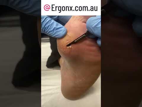 Satisfying Callus Removal by Podiatrist ASMR | See the Magic of a Scalpel #Callus #FootCare