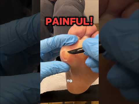 Painful Corn Removal! 👣🔪 Ever wondered why a corn keeps coming back, even after it’s been removed?