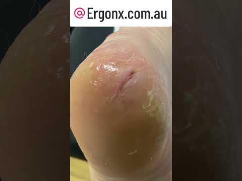Transform Your Heels: Podiatrist's Cracked Callus Removal Treatment #Skincare #FootCare