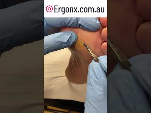 Satisfying Corn Removal on Feet | Podiatrist Foot Care | #Satisfying #FootCare #Podiatry