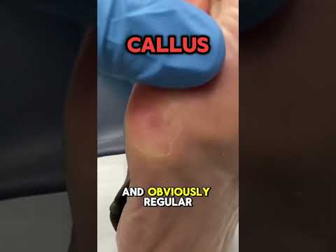 Painful Foot Callus 😖👣 This painful callus has formed under the 5th metatarsal head (the outside