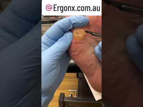 Satisfying Slow Motion Callus & Corn Removal from Foot #Satisfying #FootCare