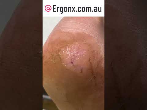 Satisfying Cracked Heel Callus Removal in Slow Motion by Podiatrist #Podiatry #Satisfying