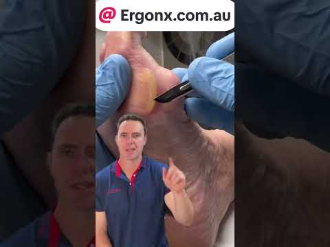 Forefoot Calluses in Tradies: Causes and Care