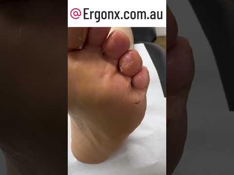 Podiatrist's Guide: Safely Removing Callus Blood Blisters #FootCare #ErgonX #Docpods